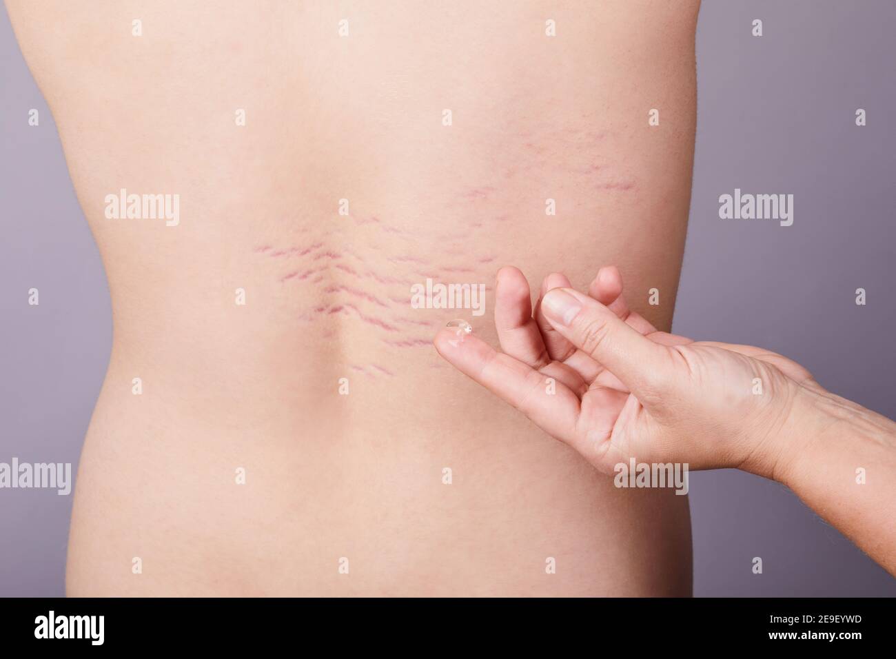 Close up view of the back with striae distensae (striae rubrae) on the  skin. The concept of impaired skin elasticity during puberty Stock Photo -  Alamy