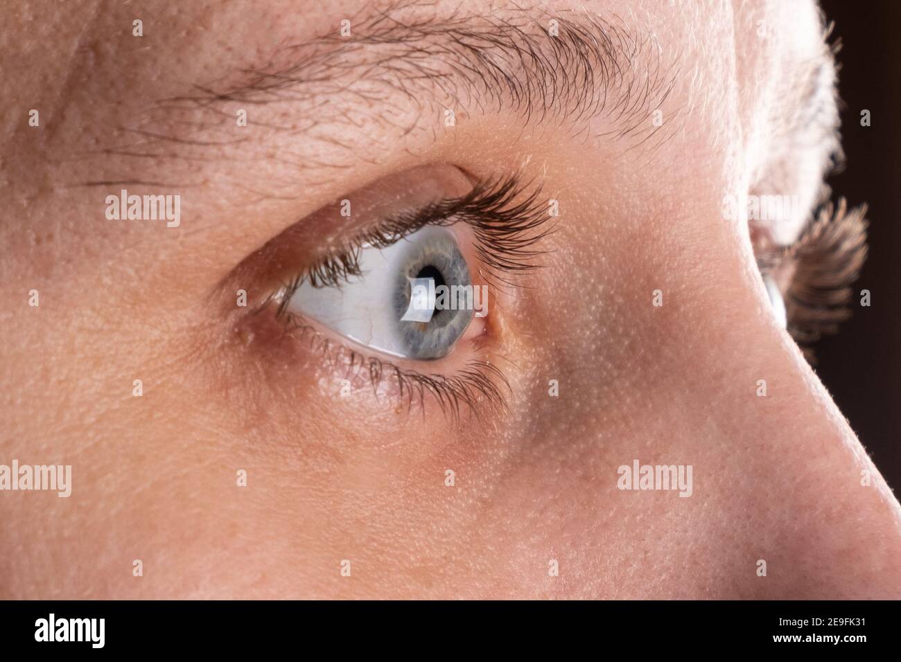 woman eye with corneal dystrophy, keratoconus, thinning of the cornea Stock Photo