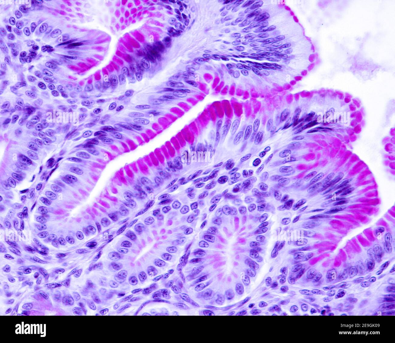 Gastric mucosa where the intense PAS positivity of the epithelium lining the inner surface of the stomach and the gastric pits is observed. Stock Photo