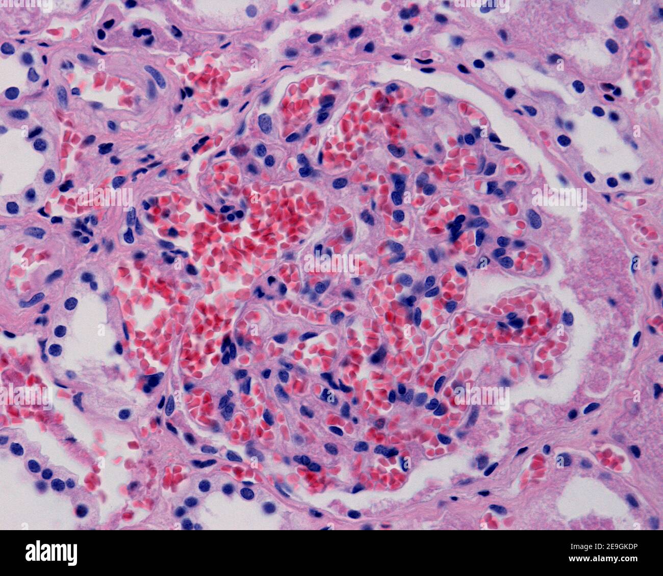 Diseased kidney showing glomerular and peritubular congestion. The glomerular capillaries appear very dilated and full of red blood cells. Human kidne Stock Photo