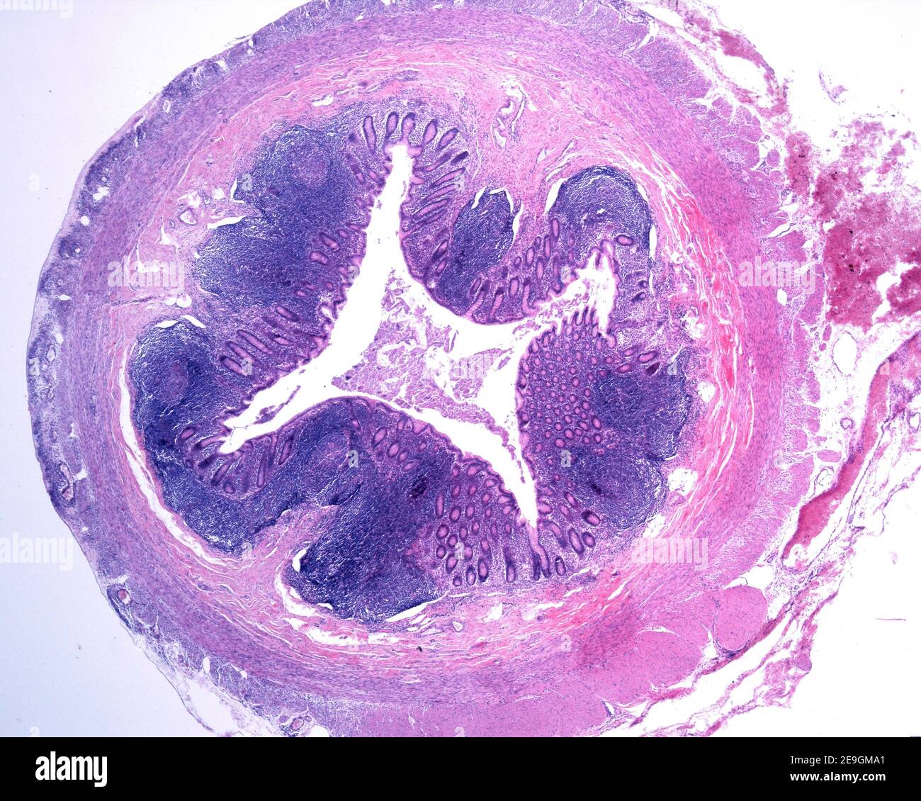 Cross section of a human vermiform appendix. The wall is thickened due to the presence of numerous lymphoid follicles in both mucosa and submucosa lay Stock Photo