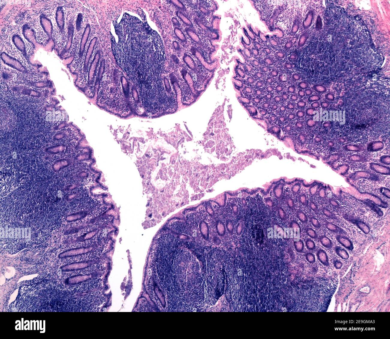 Light micrograph of the mucosa of a very inflamed human vermiform appendix, showing numerous lymphoid follicles and aggregations of inflammatory cells Stock Photo