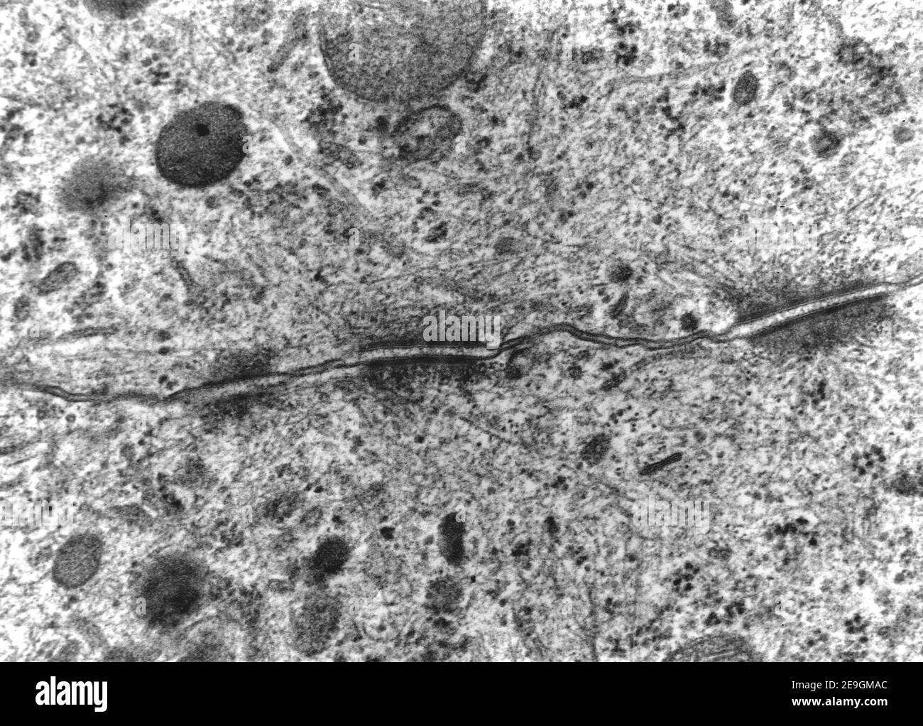 Transmission electron microscope (TEM) micrograph showing three desmosomes (maculae adherentes) with prominent dense plaques where keratin intermediat Stock Photo