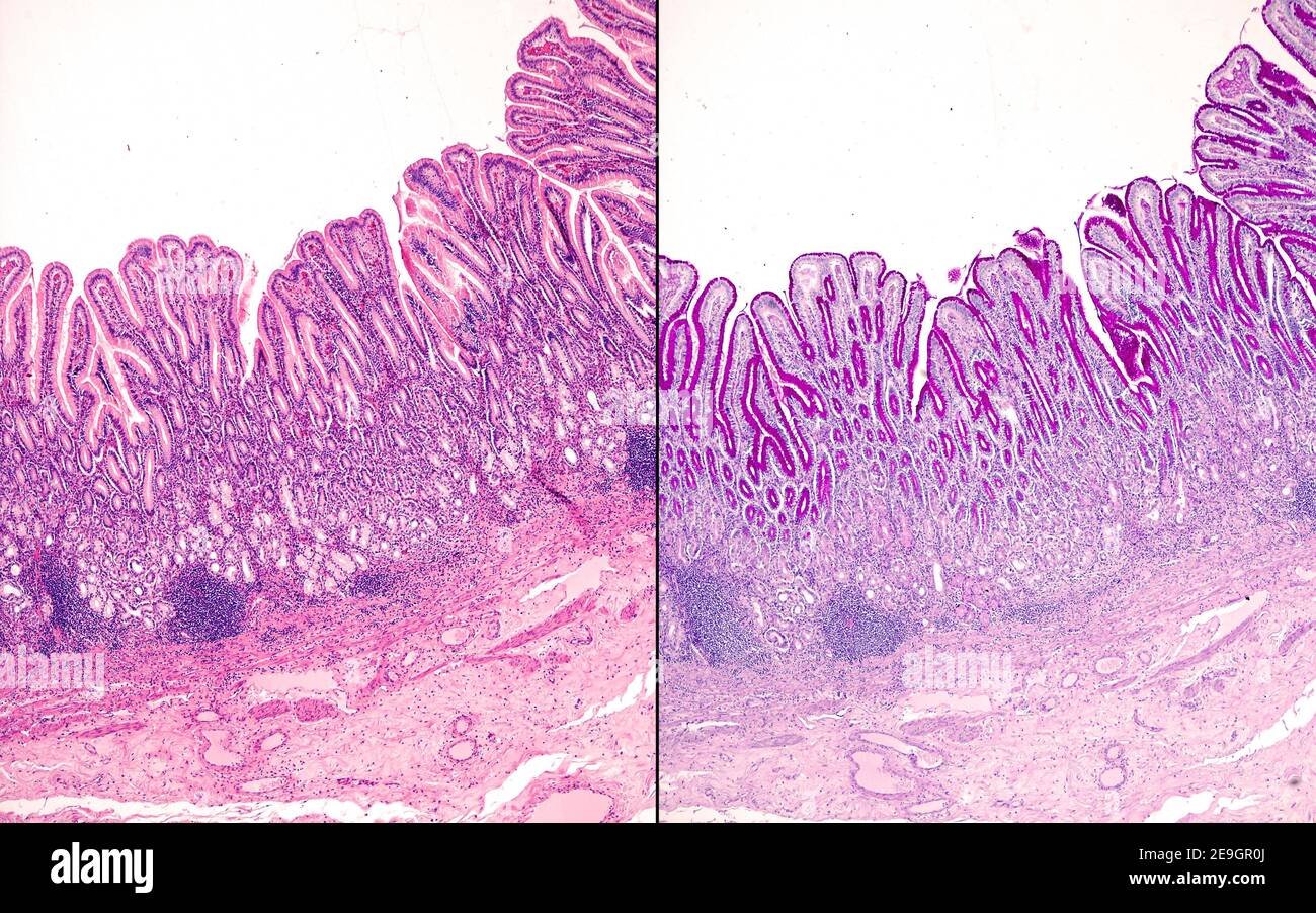 Gastric mucosa of the pyloric antrum stained with hematoxylin-eosin (left) and PAS method (right). The surface epithelium and gastric pits are PAS+ Stock Photo