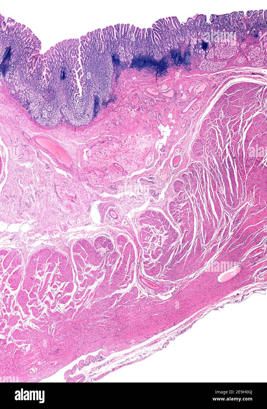 Pylorus. Transition between the gastric mucosa of the pyloric antrum (left) and duodenum (right) which show Brunner glands. Below, pyloric sphincter Stock Photo