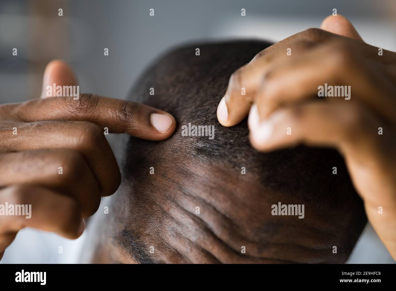 Young African Men Hair Loss. Watching Hairloss Stock Photo