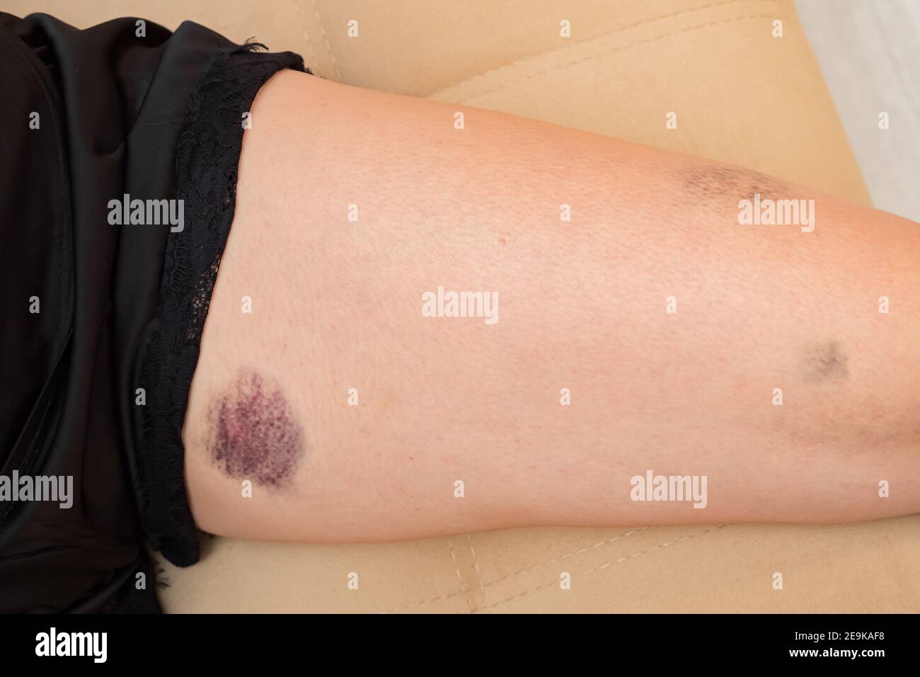 female leg with blue and pink bruise closeup Stock Photo