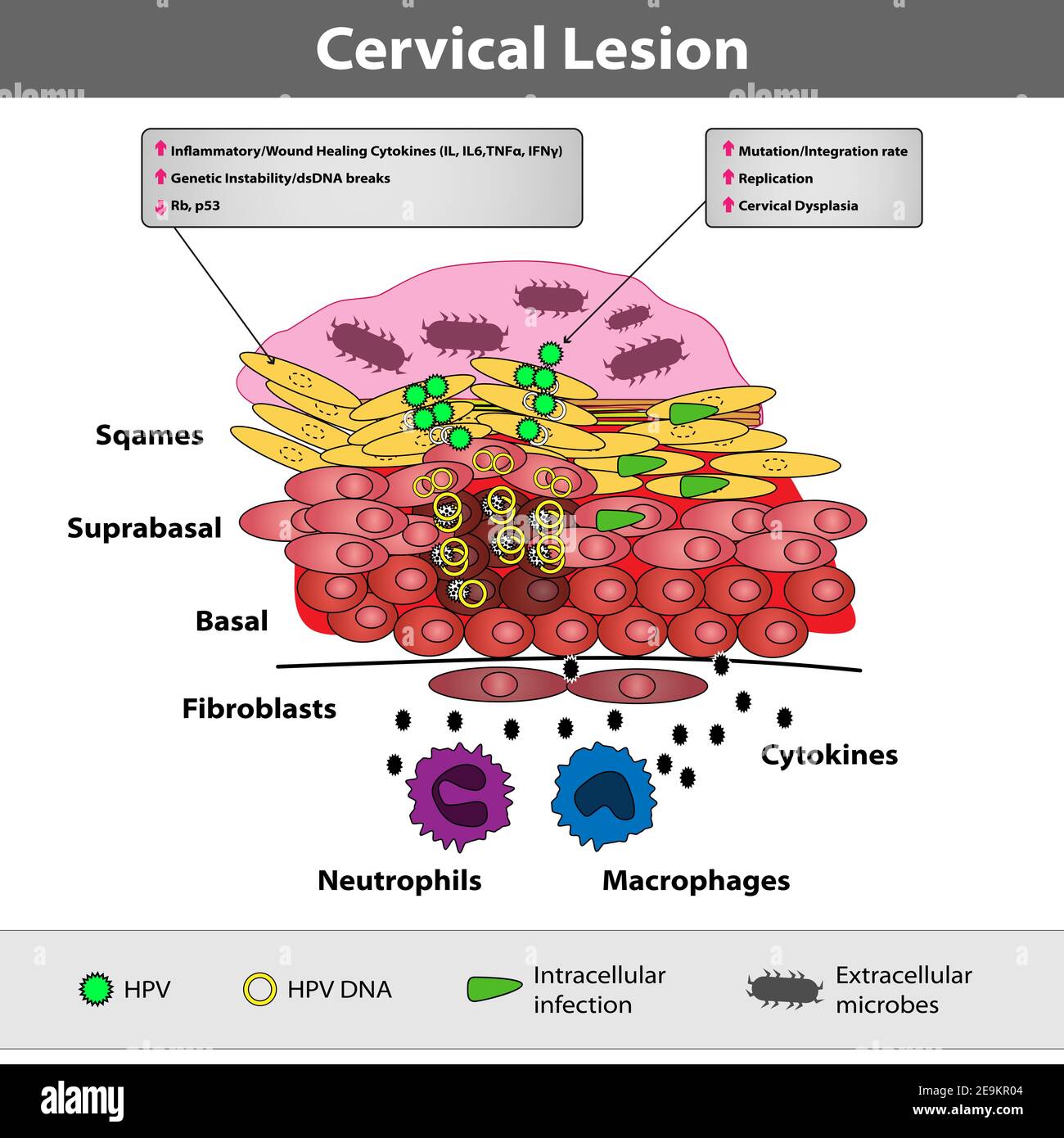 A precancerous cervical lesion. Abnormal cervical appearance. Squamous