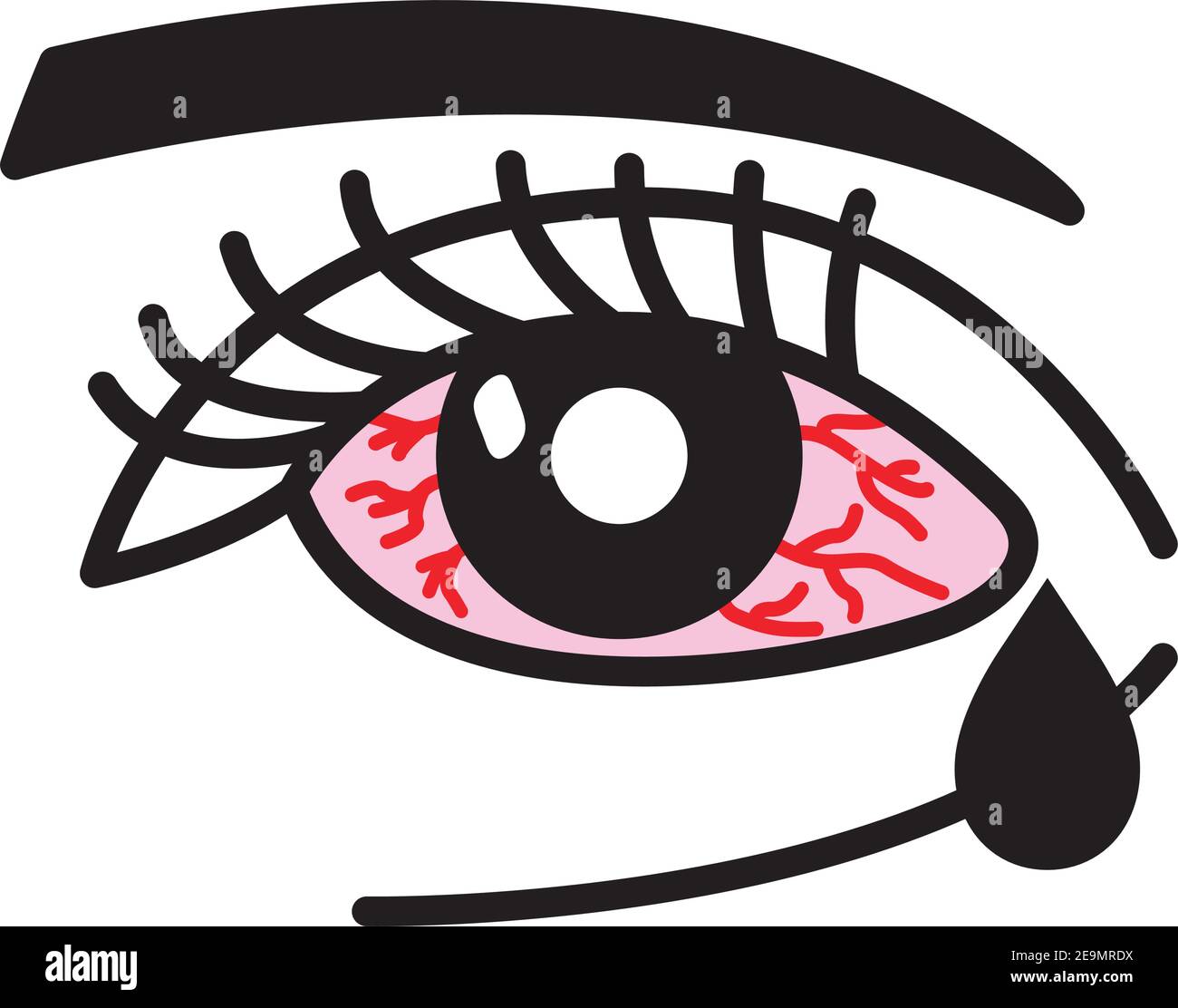 Inflammated eye Conjunctivitis or pink eye Stock Vector Image & Art - Alamy