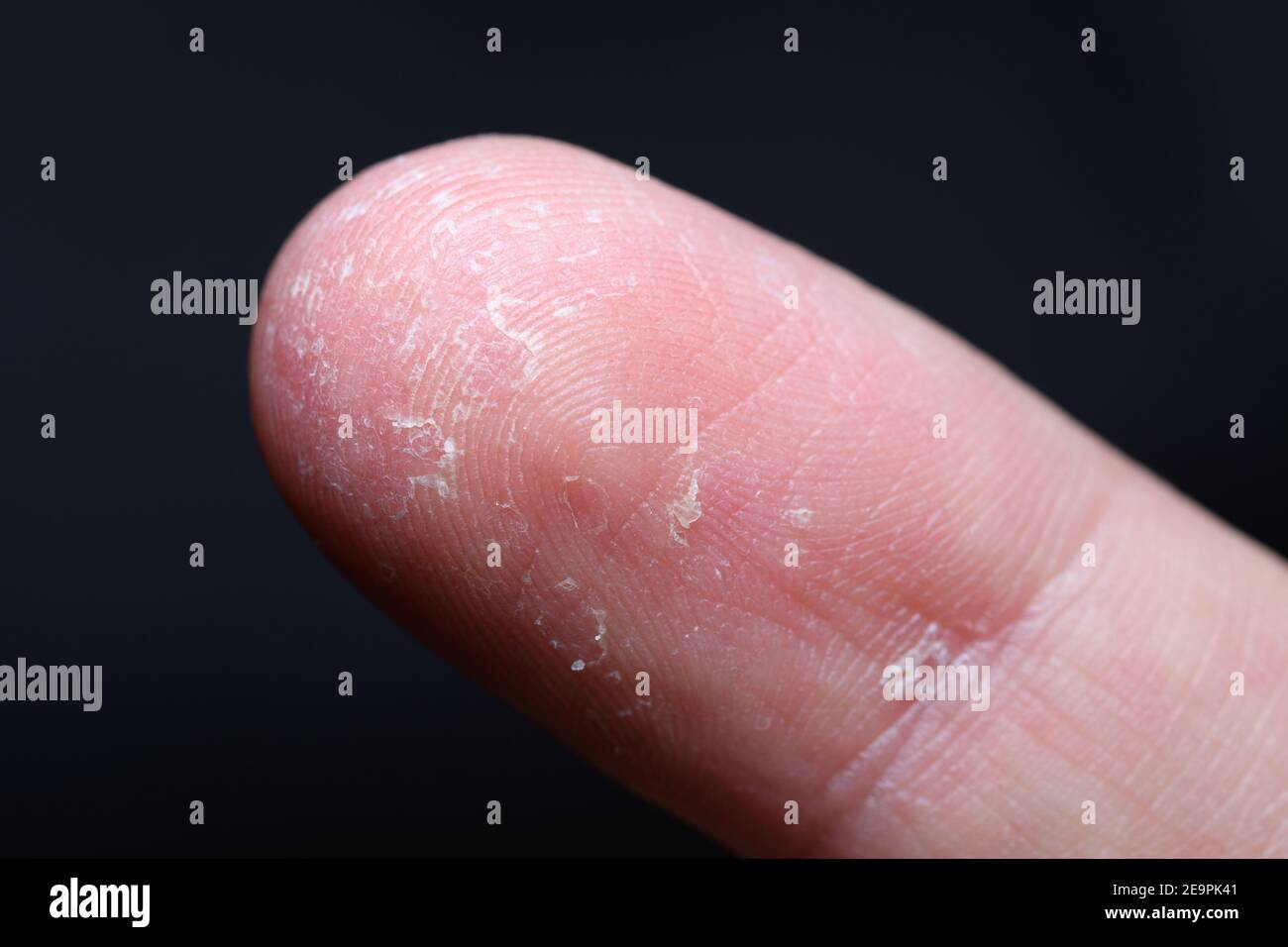 Close up of a finger with dermatitis Stock Photo Alamy
