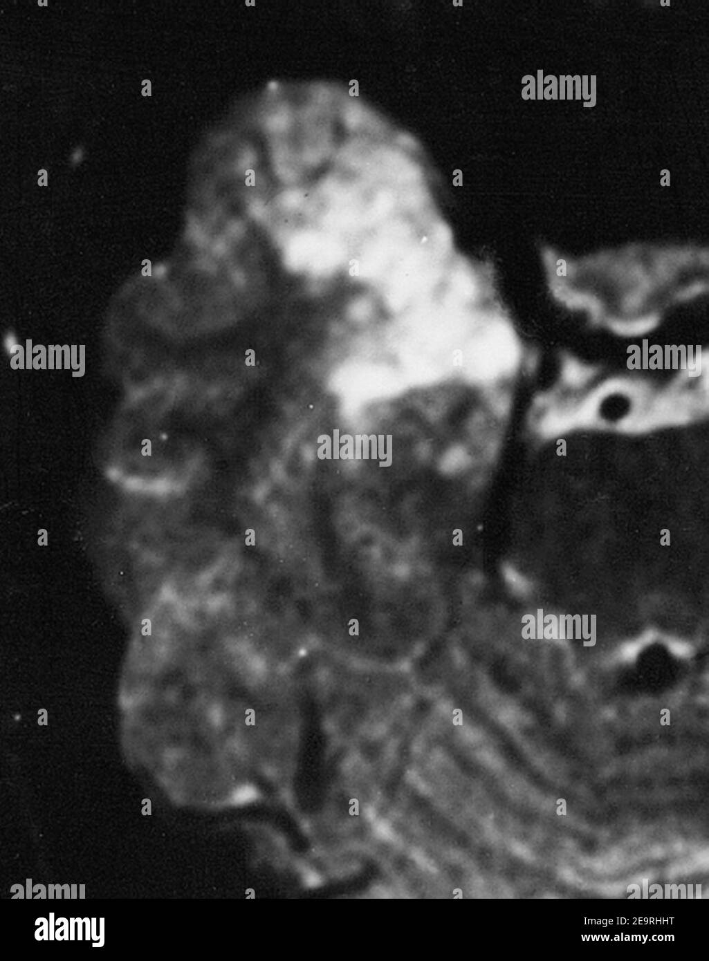 MRI of a Dysembryoplastic Neuroepithelial Tumor Stock Photo Alamy