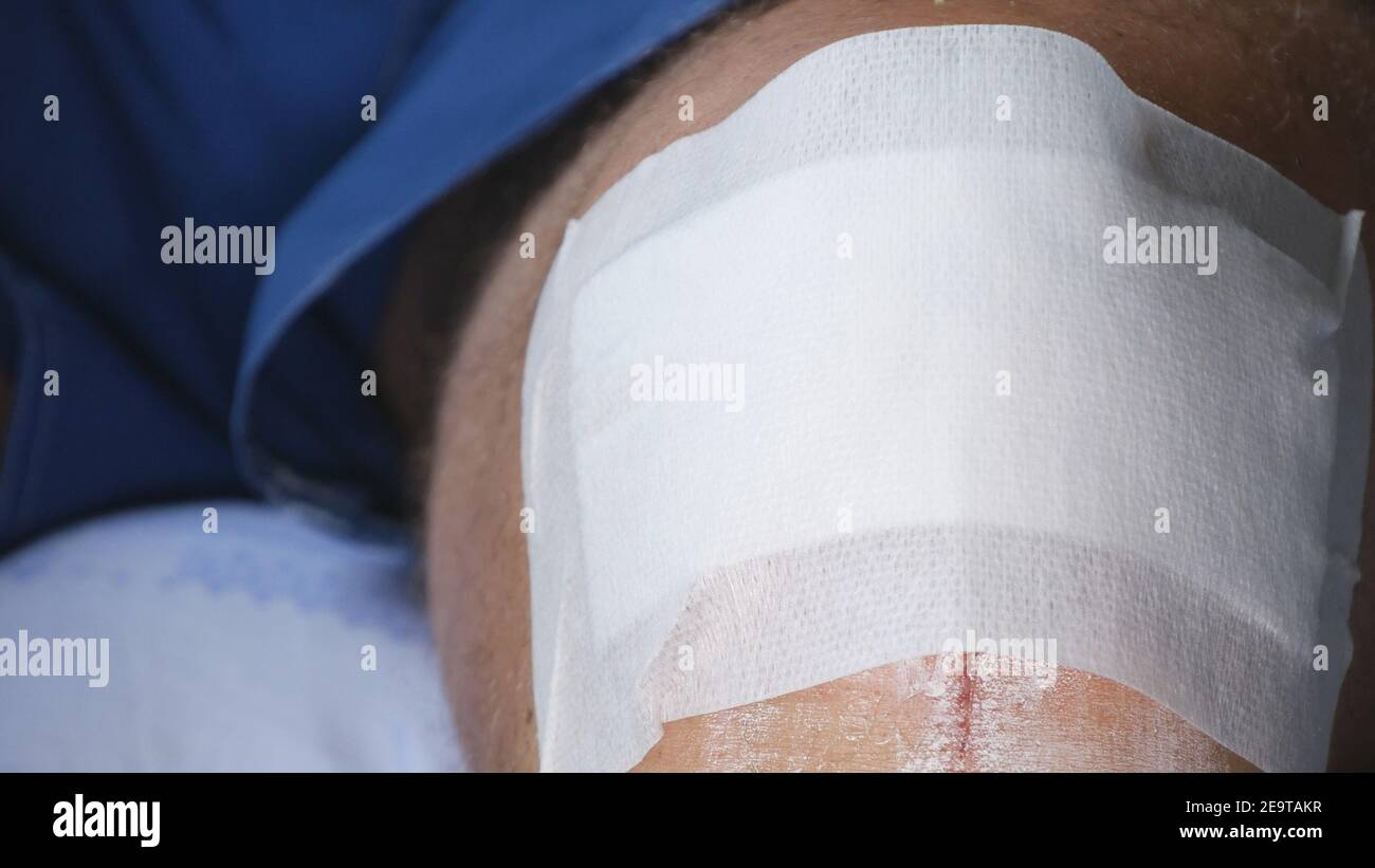 Close Up Image with a Bleeding Wound on the Knee. Medical Treatment at the Emergency Hospital. Stock Photo