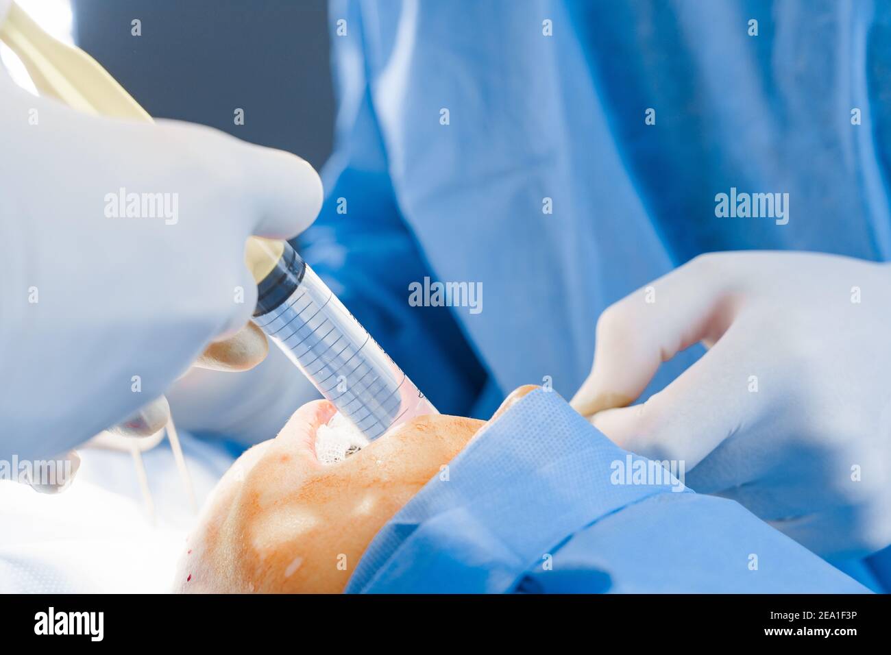 Anesthesia thigh injection before Buccal fat removal. Bisha lumps