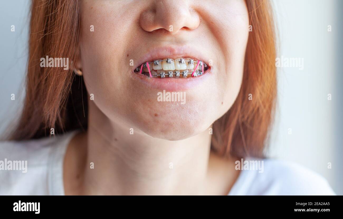 Braces in the smiling mouth of a girl. Closeup photos of teeth and
