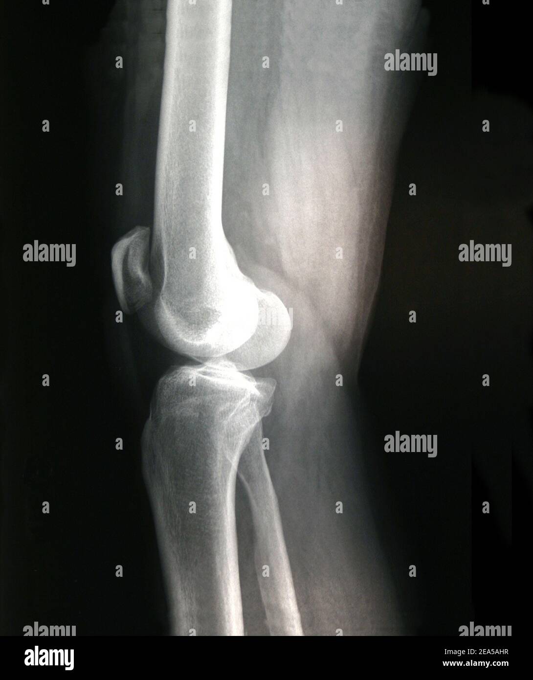 X-Ray Right Knee - Male Stock Photo