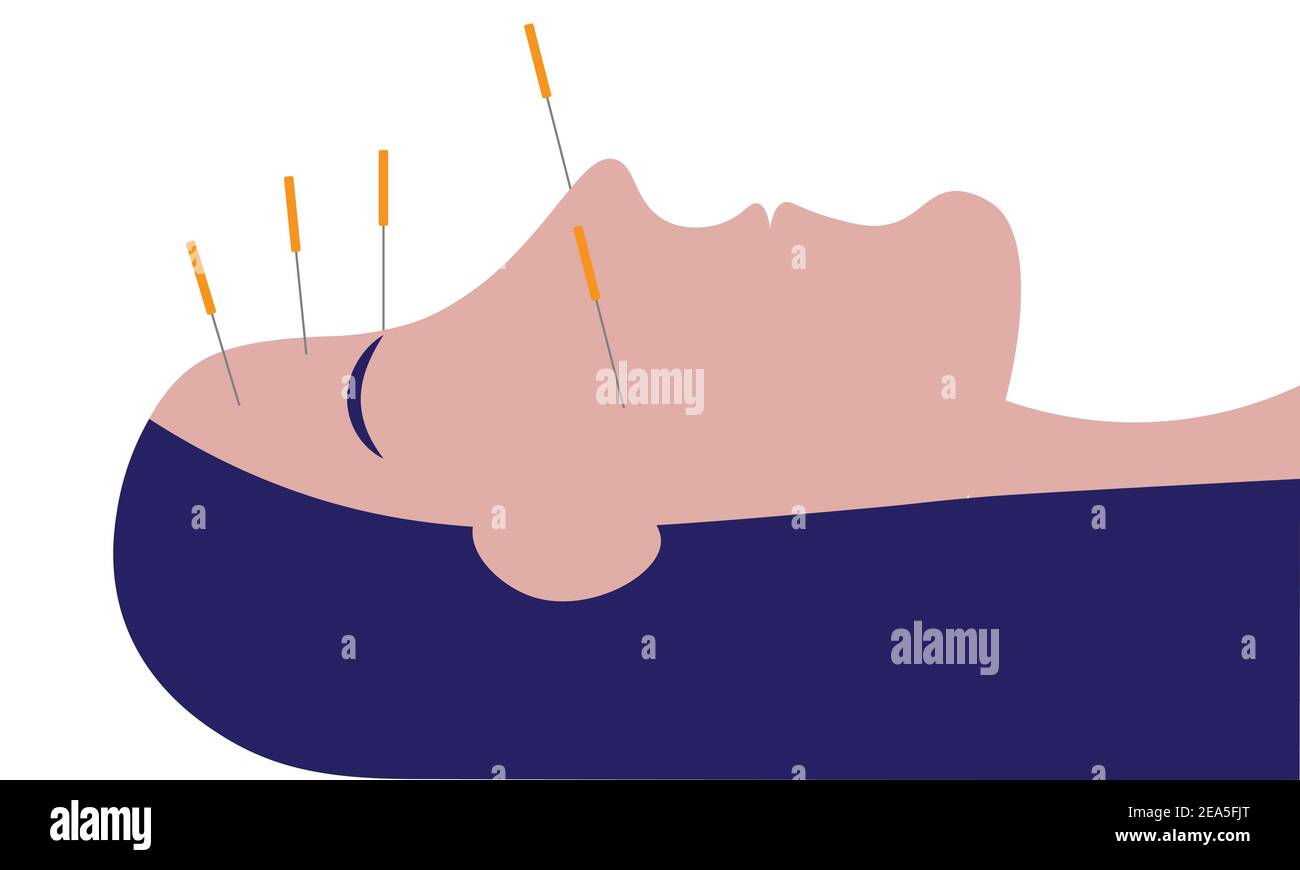 Acupuncture on a woman's face - Alternative therapy for migraine Stock Vector