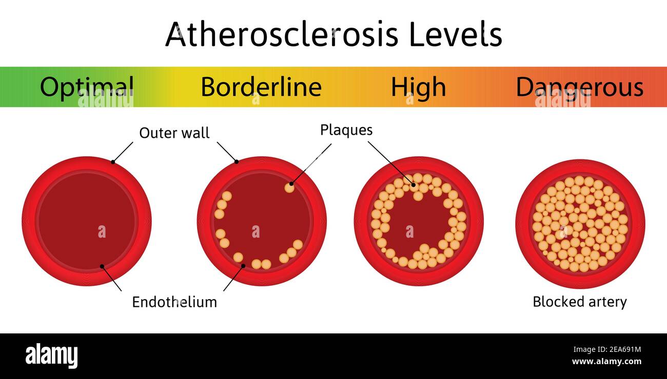 Atherosclerosis levels. Different stages of atherosclerosis arterial