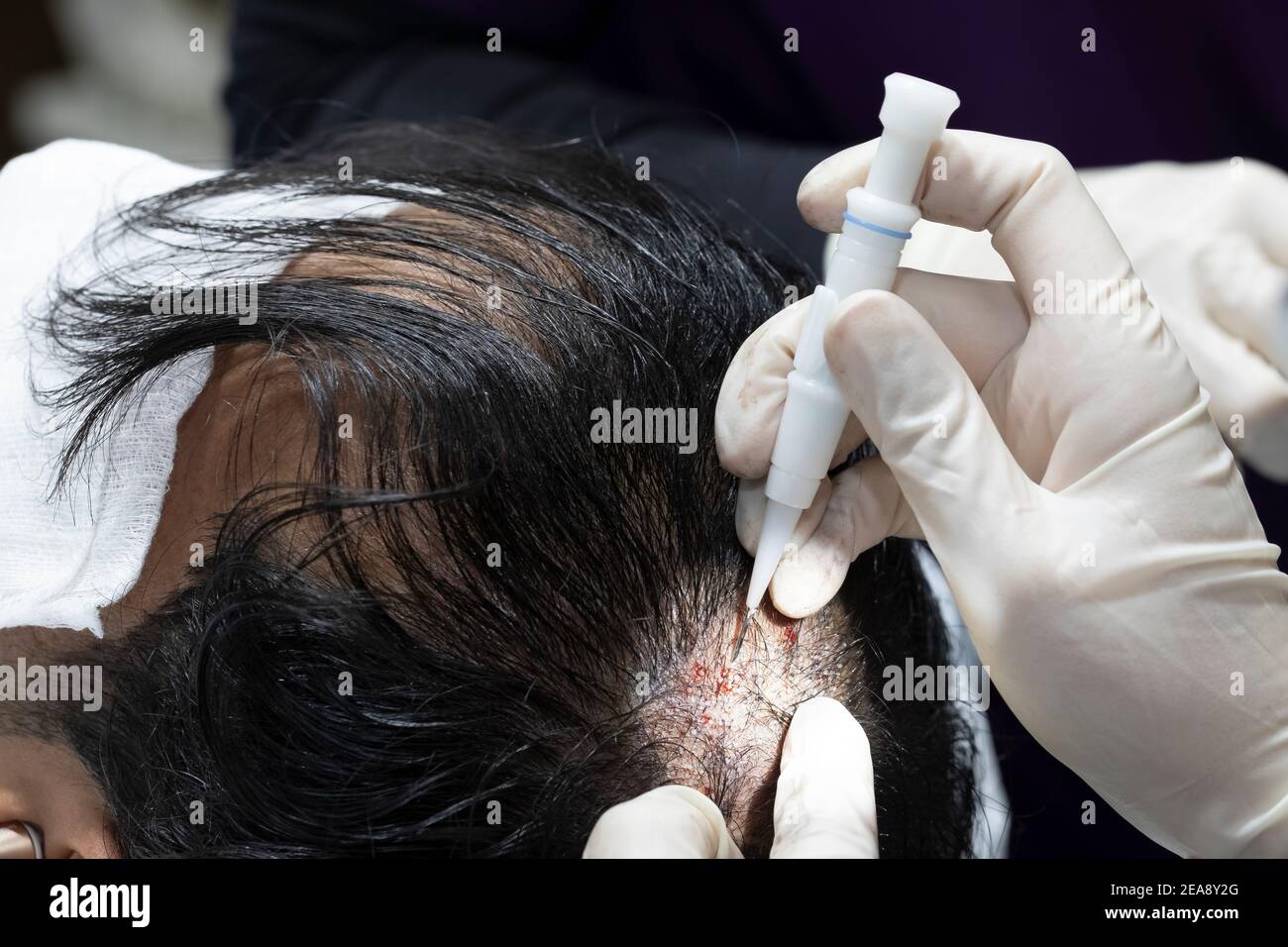 Hair follicles hires stock photography and images Alamy