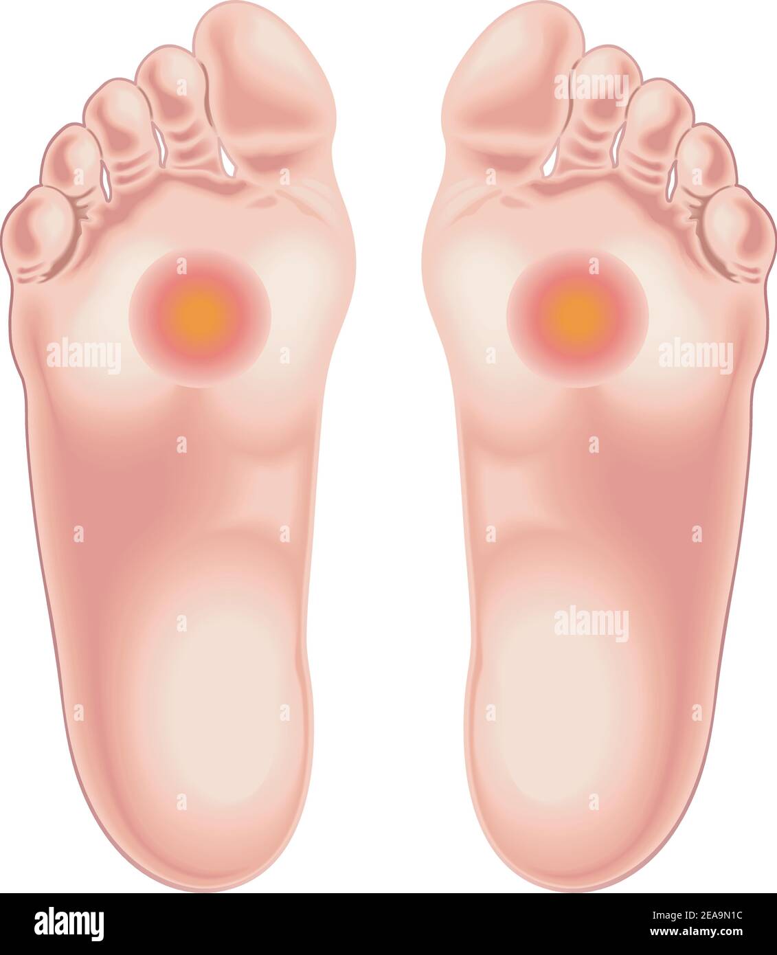Illustration shows the feet area afflicted by the pain caused by metatarsalgia. Stock Vector