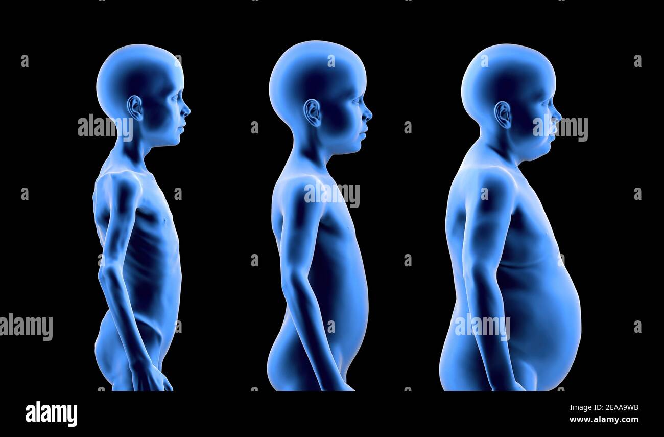 Undernourished child, with normal build and obese child in comparison. Problems of food shortage and obesity in children. 3d render Stock Photo