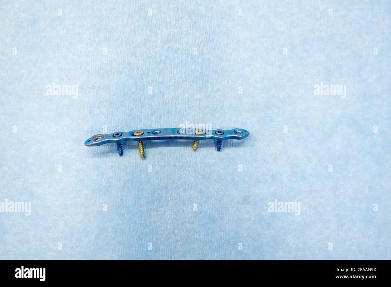 an explanted titanium plate and 4 titanium screws for the treatment of