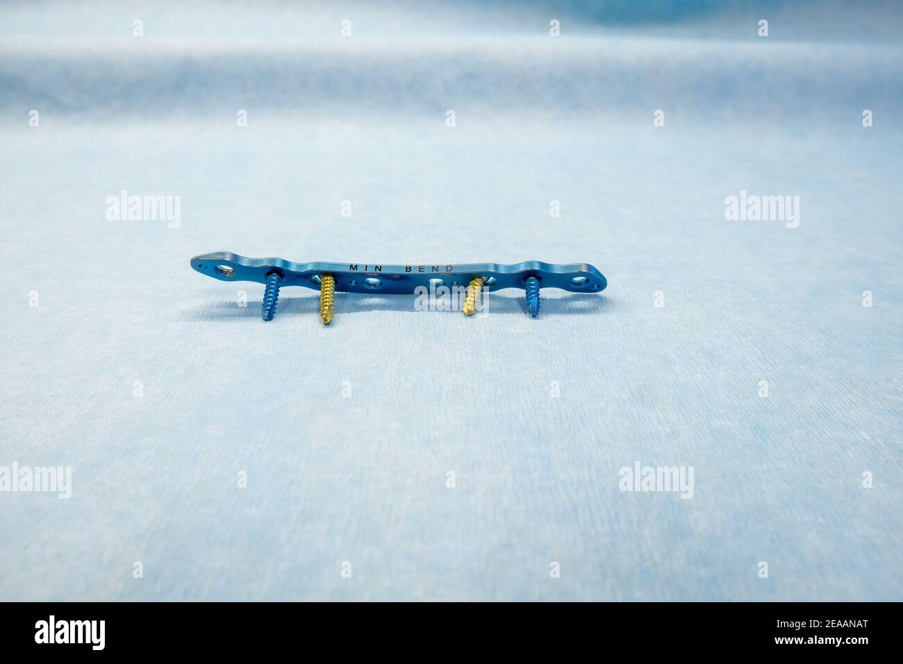 an explanted titanium plate and 4 titanium screws for the treatment of