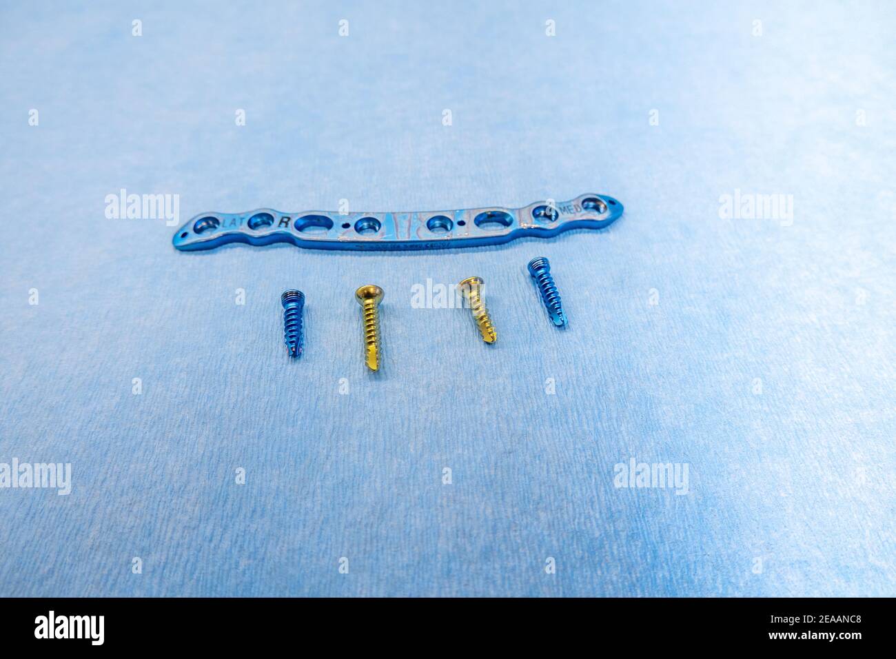 an explanted titanium plate and 4 titanium screws for the treatment of