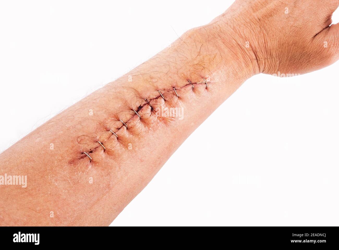 Stitches removed hi-res stock photography and images - Alamy