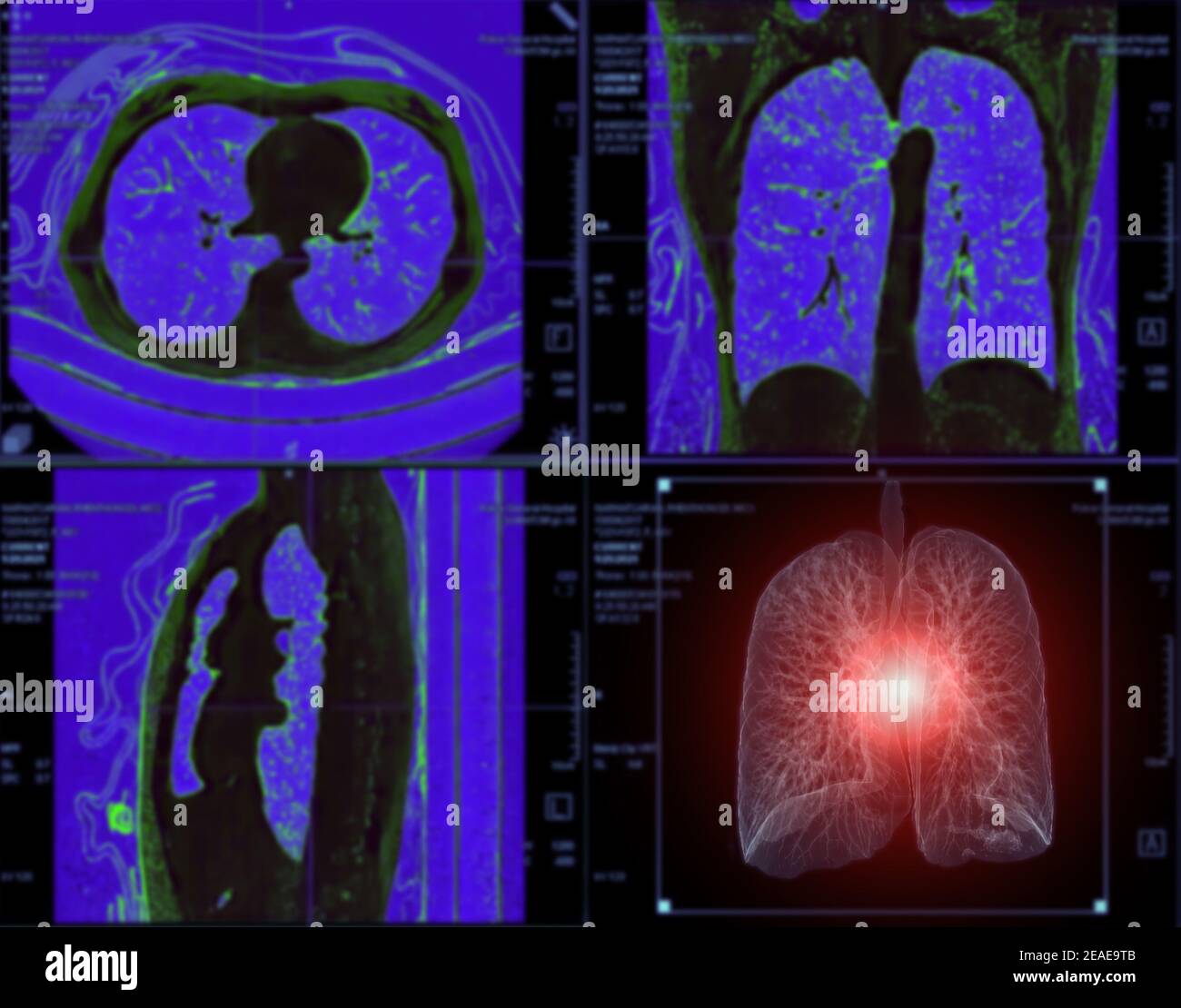 Selective focus of CT Chest or Lung 3D rendering image on the monitor  for diagnosis TB,tuberculosis and covid-19 . Stock Photo