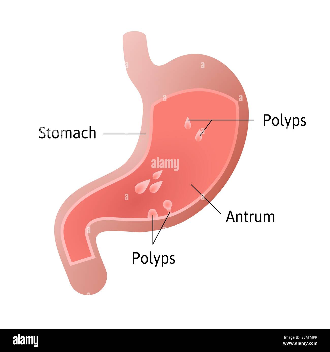 gastric polyps, masses of cells that form on the lining inside stomach. pedunculated and flat-based polyp. Antrum. Medical vector illustration marked Stock Vector