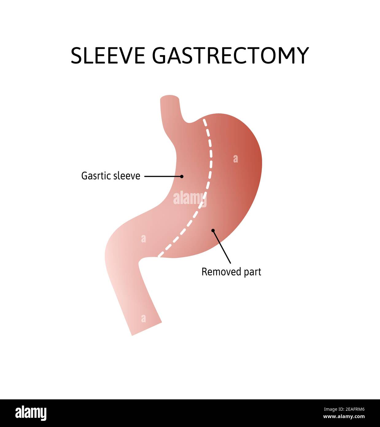 Vertical Sleeve Gastrectomy. Human stomach isolated on white background. decrease in stomach volume. vector illustration marked with lines. Stock Vector