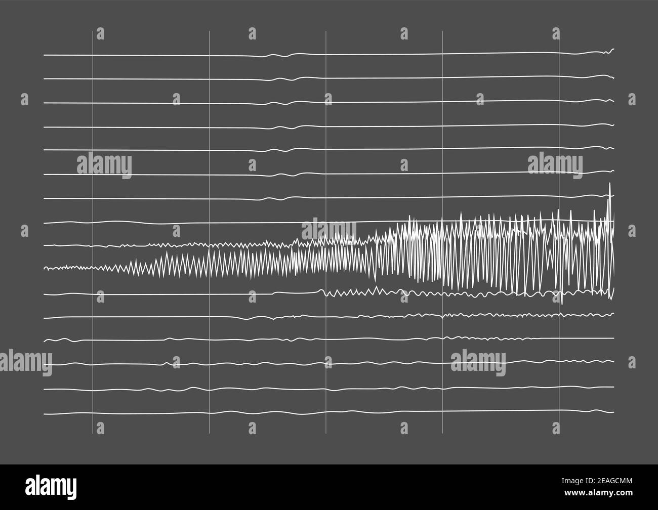 Illustration of ictal EEG recording during seizure. Seizure waves showing high amplitudes and frequency. Stock Vector