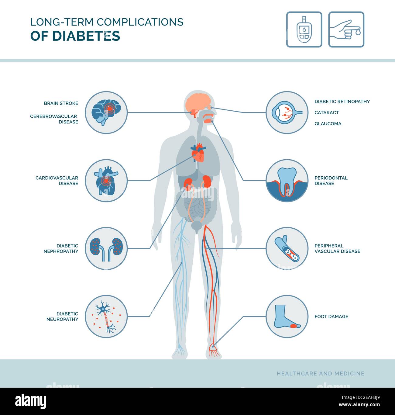 Long-term complications of diabetes medical infographic: diabetes effects on the body Stock Vector
