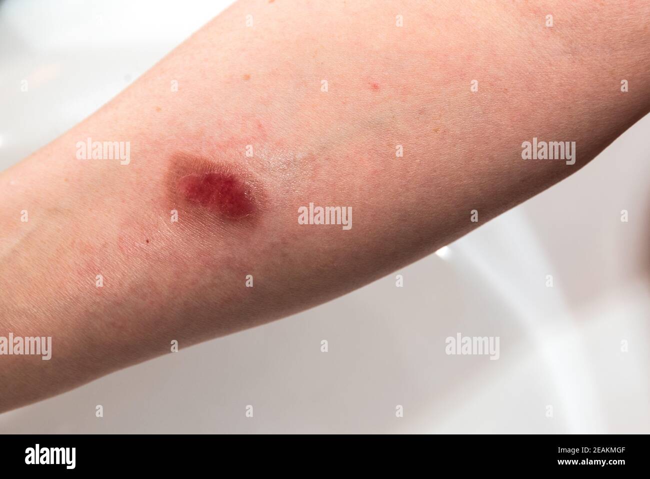 Scalded arm - burn wound Stock Photo