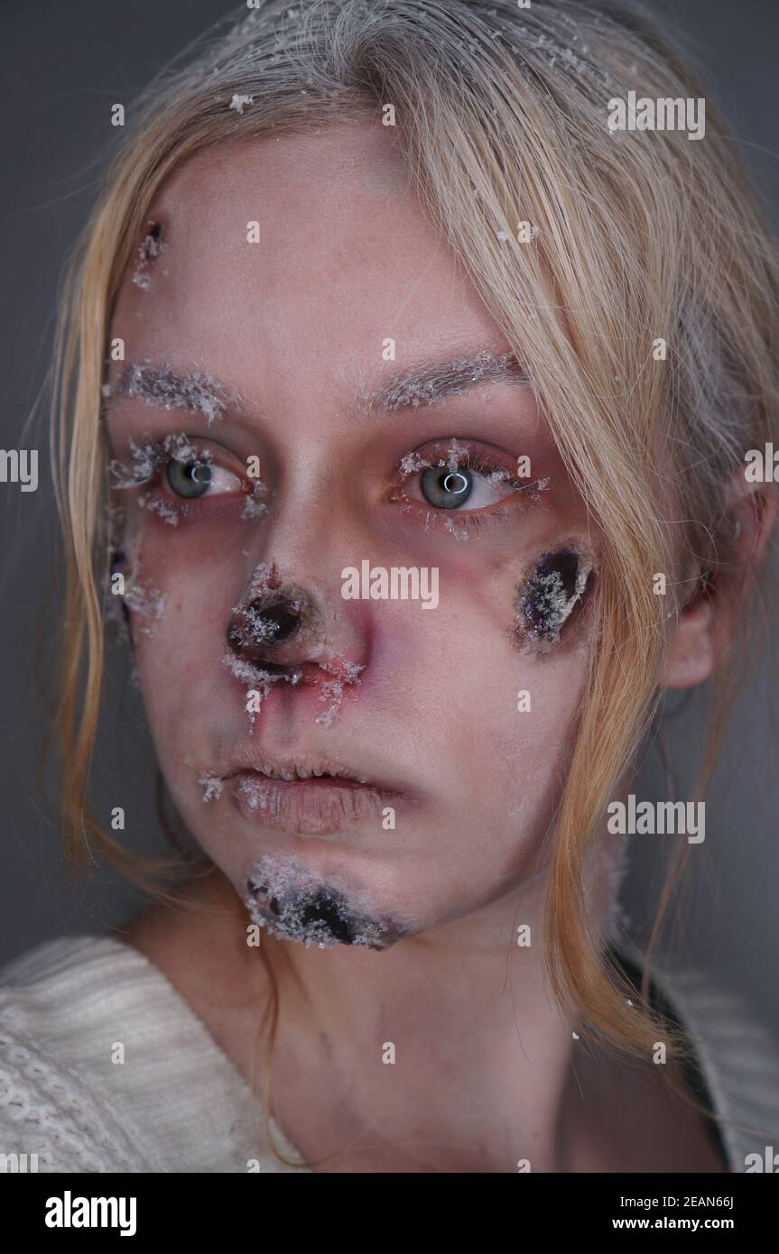 Frostbite sfx makeup Stock Photo - Alamy