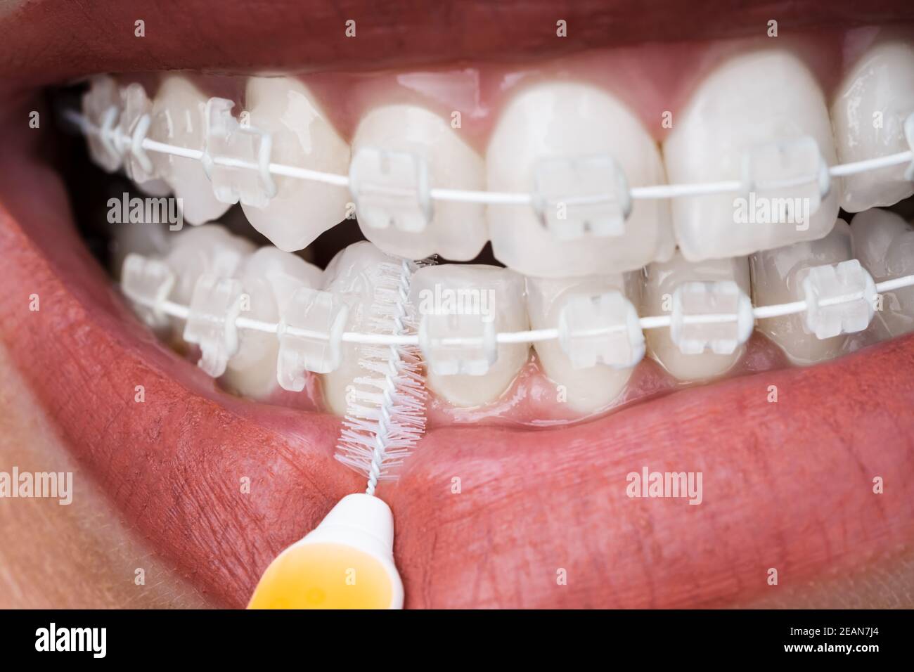 Female Cleaning Dental Brackets In Mouth Stock Photo