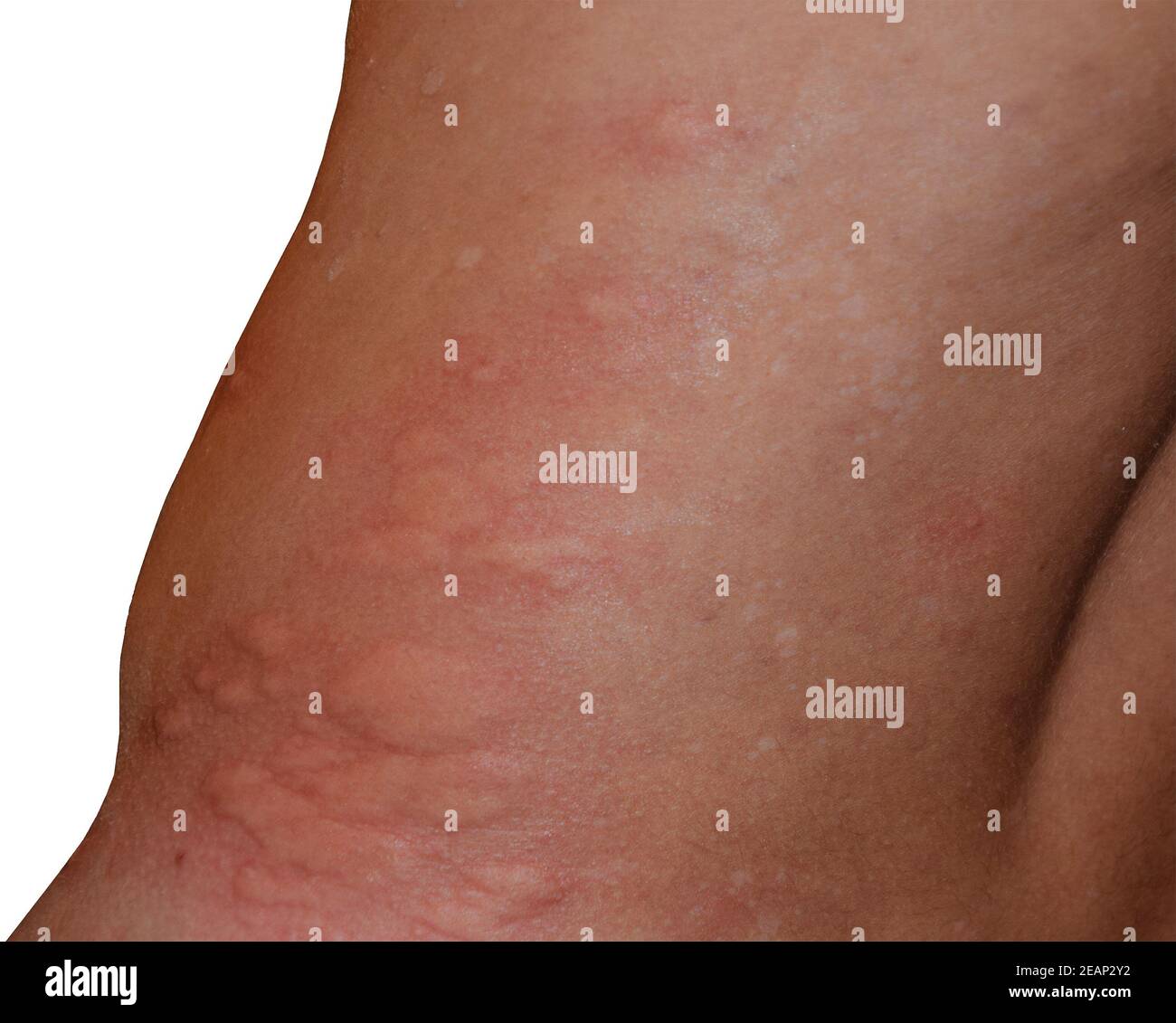 Allergy skin back and sides. Allergic reactions on the skin in the form of  swelling and redness Stock Photo - Alamy