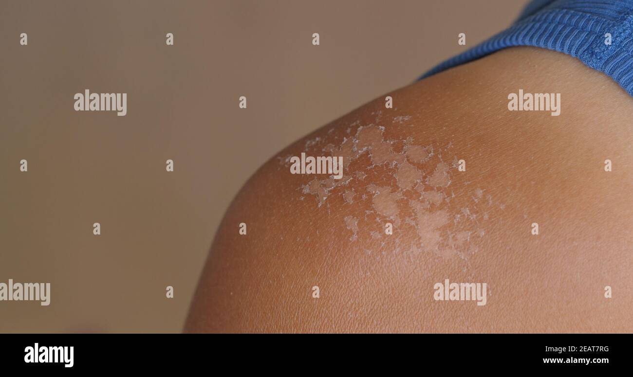 Sunburned skin, peeling skin from a sunburn Stock Photo