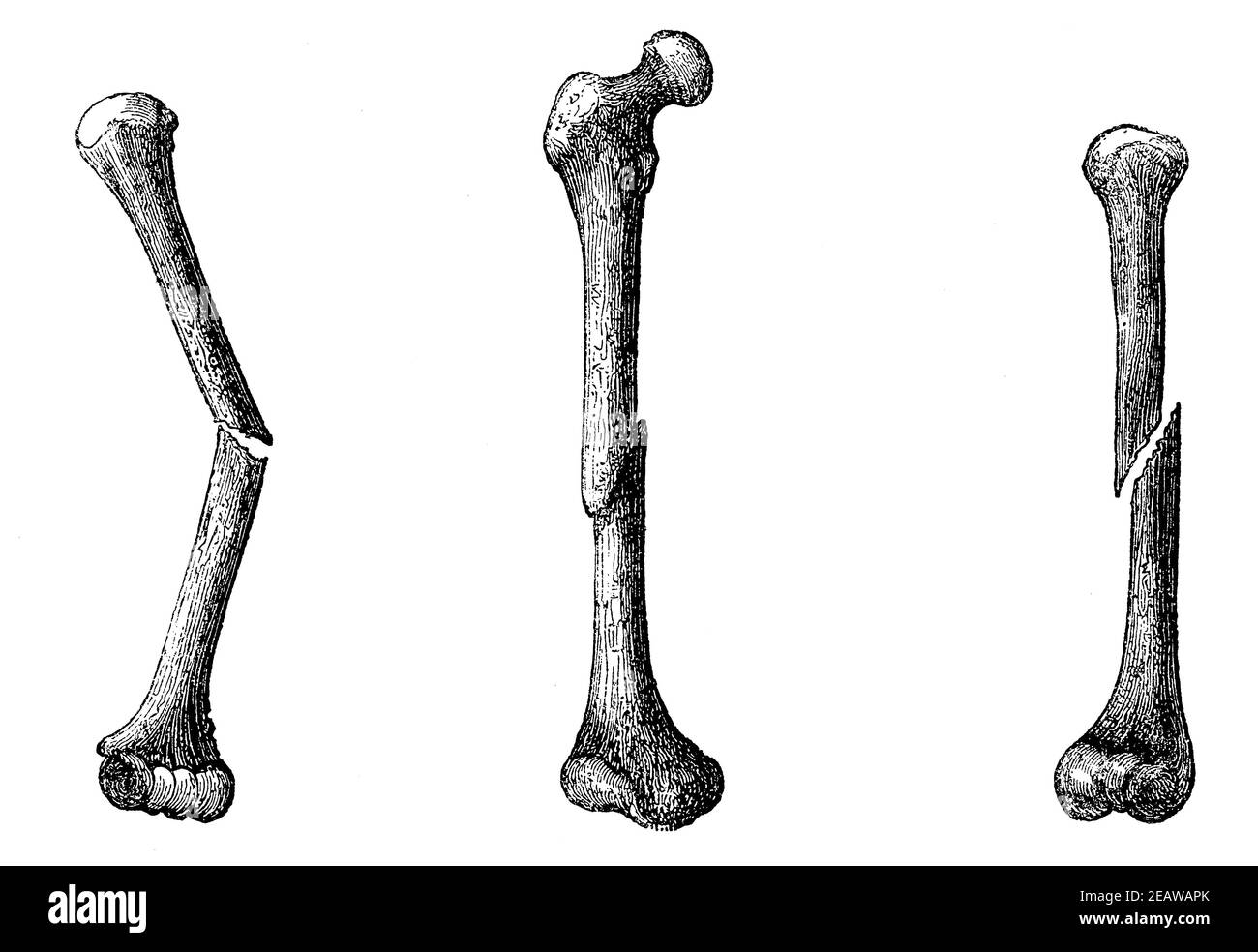 Fracture of the humerus without displacement, fracture of the femur with displacement, fracture of the humerus with displacement and rotation. Illustration of the 19th century. White background. Stock Photo