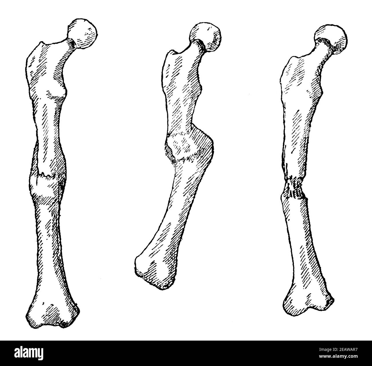 Examples of fused bones after a fracture. Correct (left) and incorrect