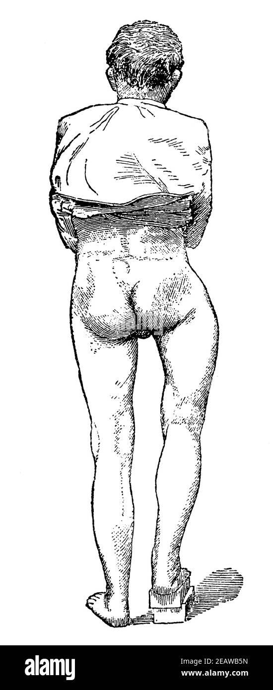 https://c8.alamy.com/comp/2EAWB5N/flexion-and-shortening-of-the-leg-as-a-result-of-a-broken-thigh-illustration-of-the-19th-century-germany-white-background-2EAWB5N.jpg