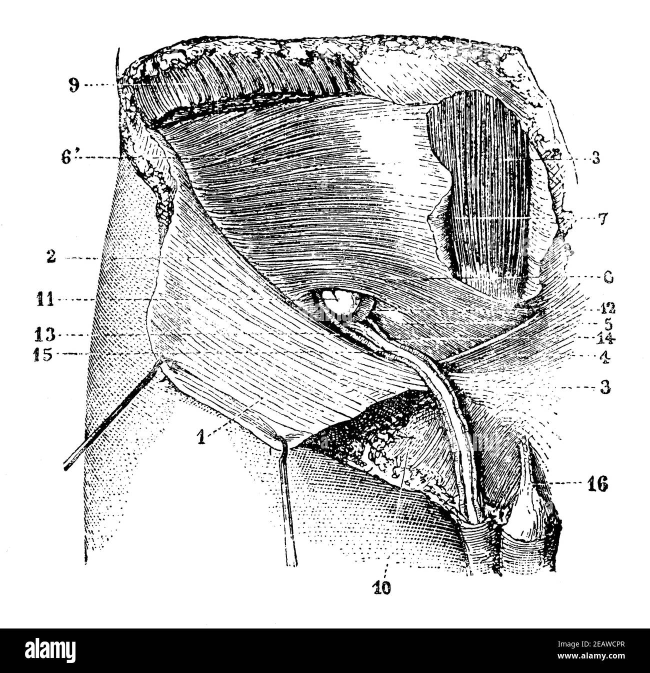 The first appearance of an inguinal hernia. Illustration of the 19th century. Germany. White background. Stock Photo