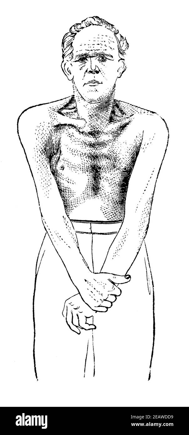 Muscle paralysis of the upper body of a worker due to chronic lead poisoning. Front view. Illustration of the 19th century. Germany. White background. Stock Photo