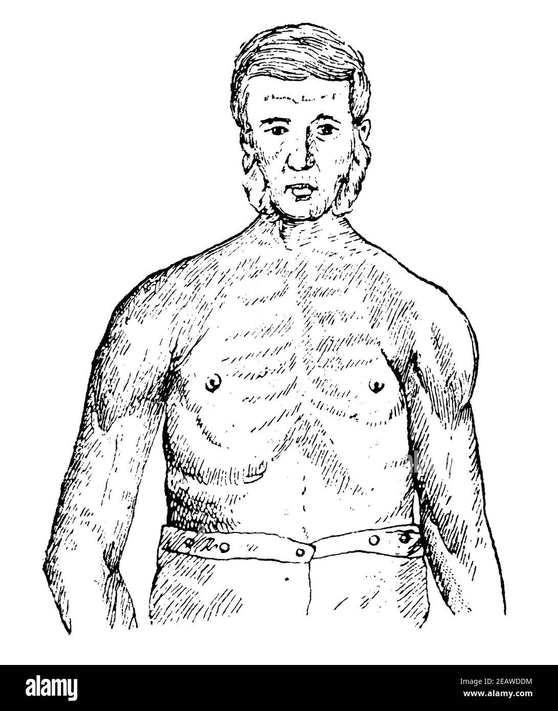 Muscle paralysis of the upper body of a worker due to chronic mercury poisoning. Front view. Illustration of the 19th century. Germany. White background. Stock Photo