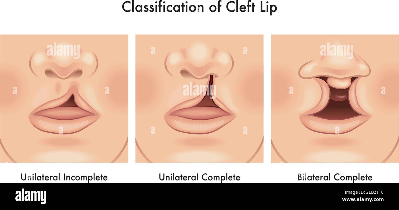 Medical illustration shows a classification of cleft lip, with annotations. Stock Vector