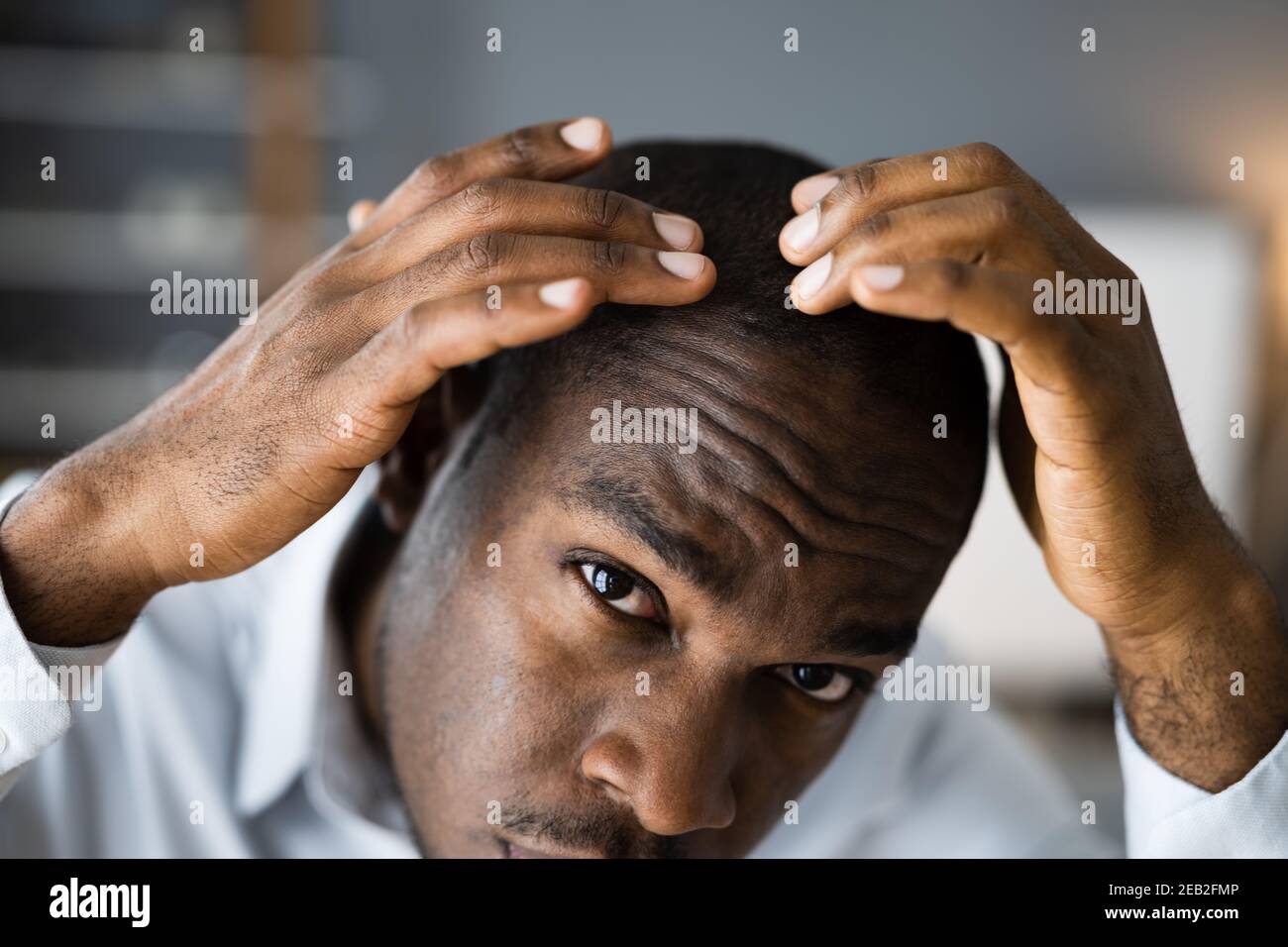 Young African Men Hair Loss. Watching Hairloss Stock Photo
