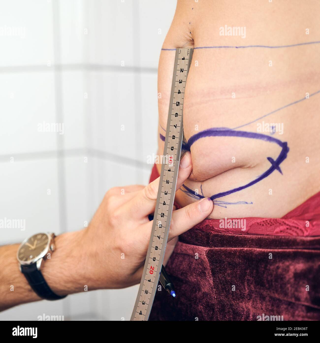 Close up of plastic surgeon hand measuring woman abdomen with ruler before cosmetic surgery. Male doctor checking belly fat of female patient. Concept of abdominoplasty and preparation for surgery. Stock Photo