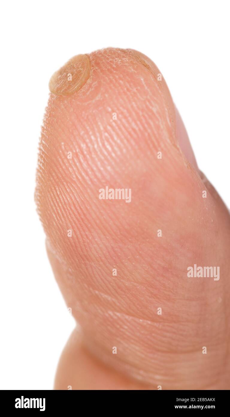 Last stage of verruca Stock Photo Alamy