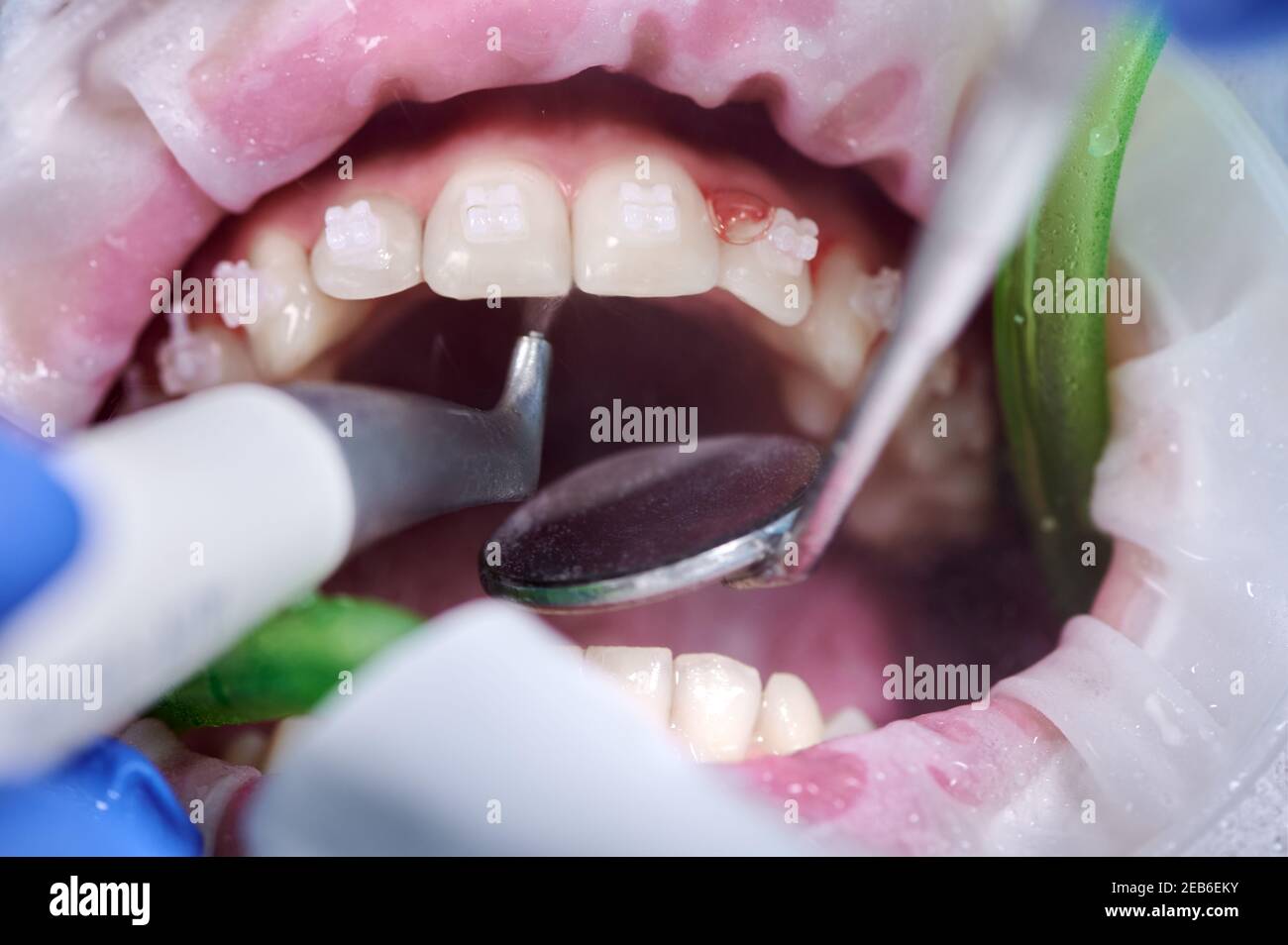 Close up photography. Top view on cleaning process in patient's mouth. Cleaning teeth with water jet and saliva ejector. Cheek retractor on the mouth. Concept of professional dental hygiene Stock Photo