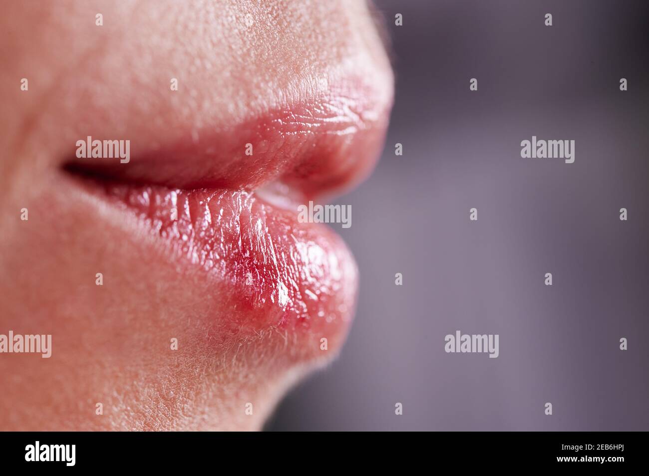 Macro photography of female lips suffering from herpes. Pimples on lower lip. Common cold virus herpes. Concept of healthcare Stock Photo